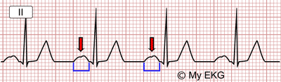 Électrocardiogramme de l'hypertrophie auriculaire gauche