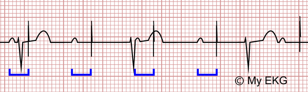 Disfonctionnements du pacemaker sur l’électrocardiogramme, Défaut de capture