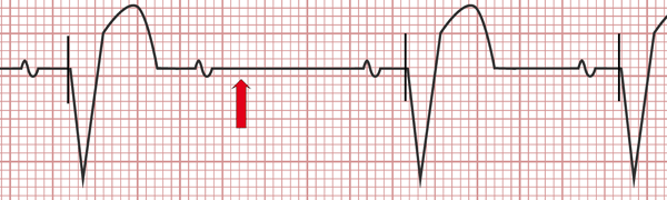 Electrocardiogram of pacemaker malfunction, Pacing spikes are absent