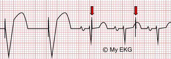 Disfonctionnements du pacemaker par hypodétection sur l’électrocardiogramme 