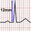 Heart Axis Calculator, positive lead