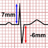 Heart Axis Calculator, slightly positive lead