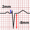 Heart Axis Calculator, negative lead