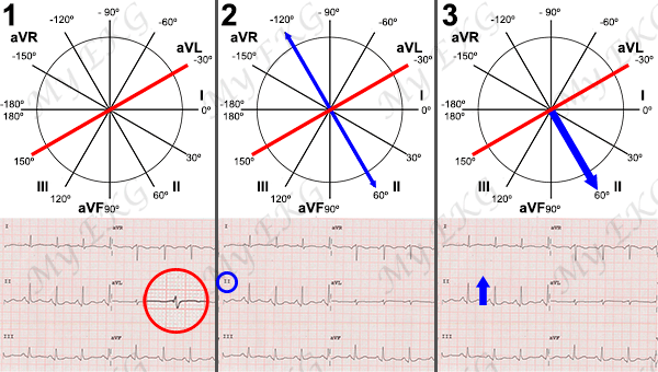 Cálculo preciso del Eje Cardiaco