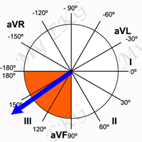 Right Axis Deviation