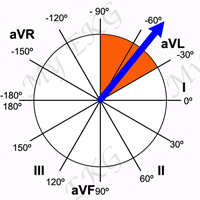 Left Axis Deviation