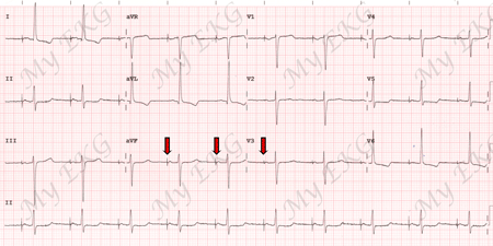 ECG com Estimulação Atrial por Marcapasso