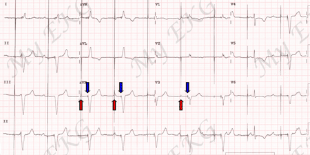 Dual chamber pacing EKG