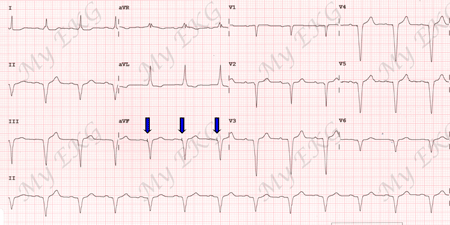 ECG com Estimulação Ventricular por Marcapasso