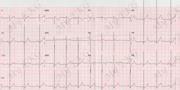 Electrocardiograma de un niño sano