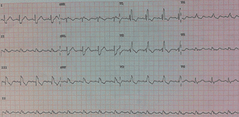 Eletrocardiograma de Tromboembolismo Pulmonar