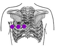 ecg verem a fogyáshoz)