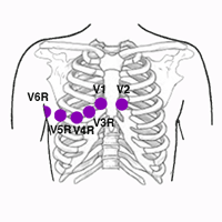 Right-Side Leads and Posterior Leads of the Electrocardiogram