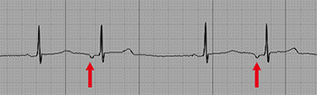 Atrial Extrasystoles, Atrial Bigeminy