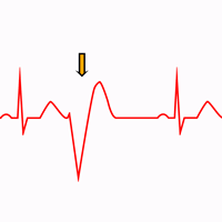 Premature Ventricular Complexes