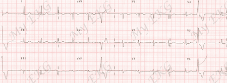 Right Ventricle Outflow Tract Premature Ventricular Complexes