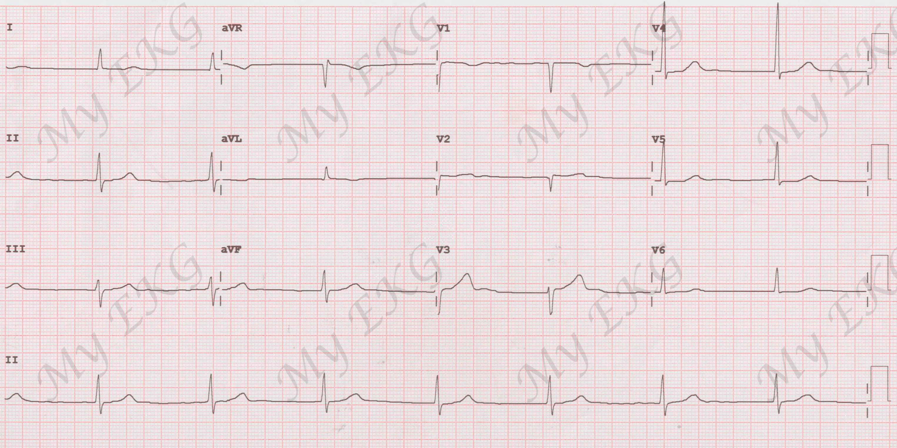 Bloqueo AV completo con Fibrilación Auricular