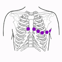 historia metal Corresponsal Electrodos del Electrocardiograma, Ubicación