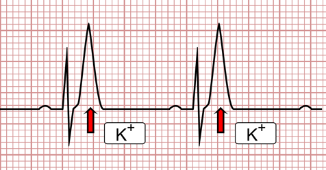 a hipertónia látható-e az EKG-n a hipertónia örökletes betegség