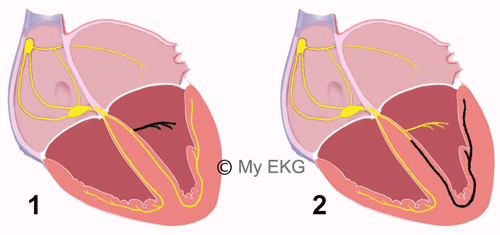 Blocs fasciculaires gauches ou hémiblocs gauches