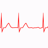 Fibrilação Atrial