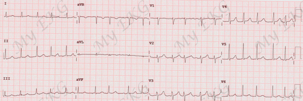 Fibrilación Auricular con Respuesta Ventricular Rápida