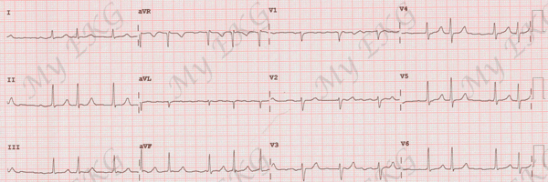 Atrial fibrillation in the EKG