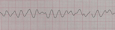 Fibrillazione Ventricolare sull'elettrocardiogramma