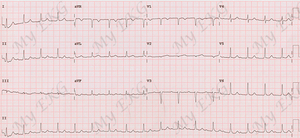 Flutter Atrial Atípico