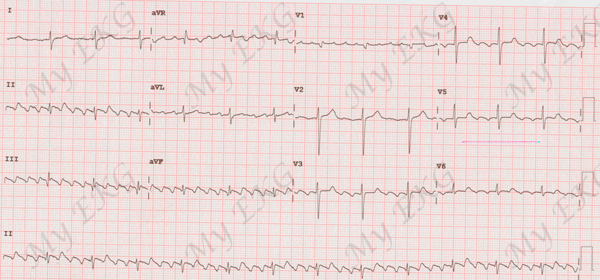 Typical counterclockwise atrial flutter