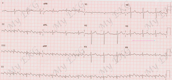 Typical Counterclockwise Atrial Flutter