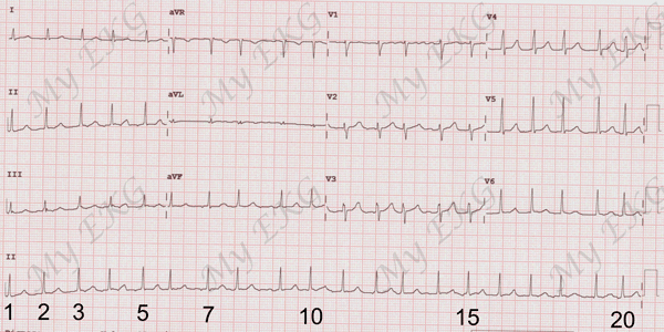 Calcul de la Fréquence cardiaque sur un électrocardiogramme dans un rythme irrégulier