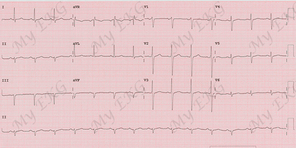 Left Anterior Fascicular Block