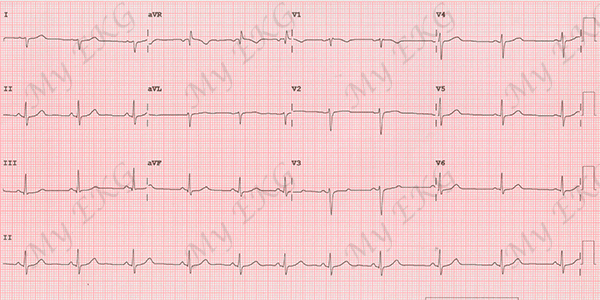 Left Posterior Fascicular Block