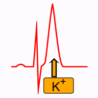 Iperkaliemia sull'elettrocardiogramma