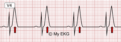 Eletrocardiograma de Hipercalemia Leve