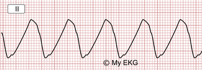 Eletrocardiograma de Hipercalemia Severa