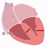 Left Ventricular Hypertrophy