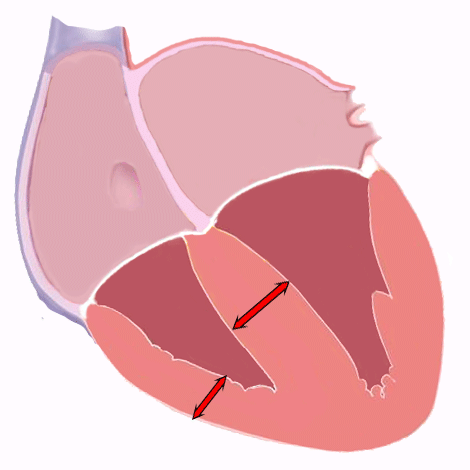 Hypertrophie ventriculaire droite sur l'électrocardiogramme