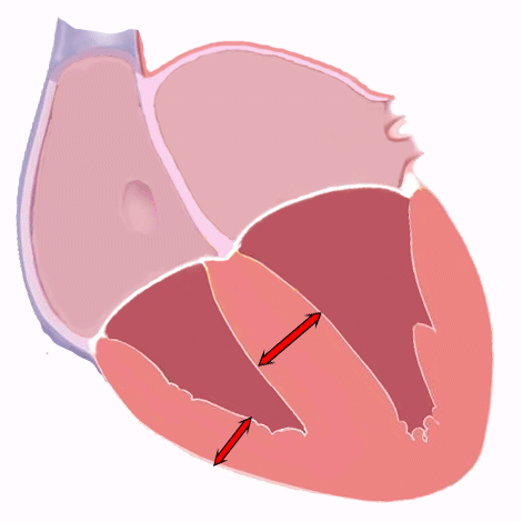 Right Ventricular Hypertrophy on the Electrocardiogram