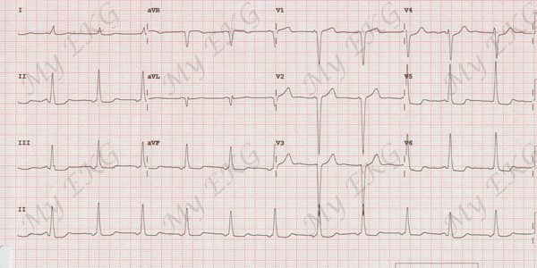 ecg verem a fogyáshoz