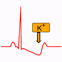 Hypokalemia on the Electrocardiogram