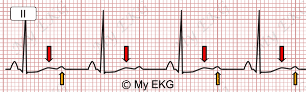 Électrocardiogramme de l'hypokaliémie modérée