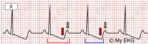 Wrong long QT  interval on Hypokalemia