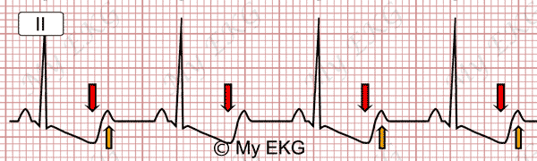 Eletrocardiograma de Hipocalemia Severa