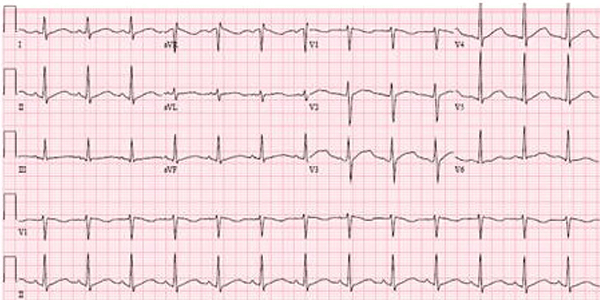 Idrossiclorochina sull'elettrocardiogramma