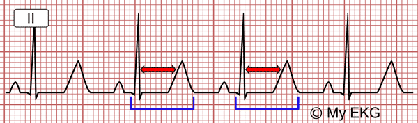 Eletrocardiograma de Hipocalcemia