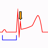 Hipotermia no Eletrocardiograma