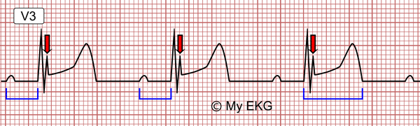 Eletrocardiograma de Hipotermia leve