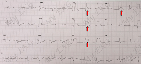 Infarto miocardico con sopraslivellamento del ST